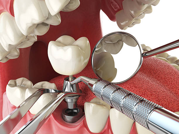 Best Emergency Dental Care for Broken or Chipped Teeth in Hackensack, NJ